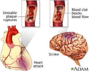 How drinking plenty of water reduce chances of heart stroke. 
